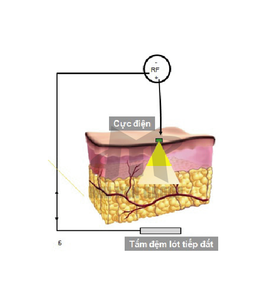 MÁY GIẢM BÉO RF ĐƠN CỰC – BARON HÀN QUỐC